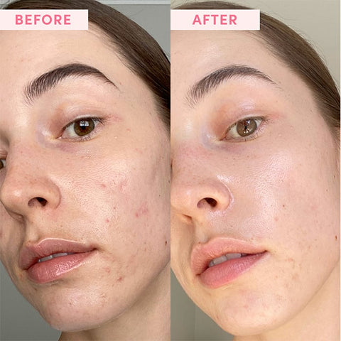 Before and after photo of woman using Australian Pink Clay Face Mask